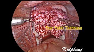 Lap adenomyomectomy: four petal technique \u0026 temporary uterine artery ligation : Dr Alka Kriplani