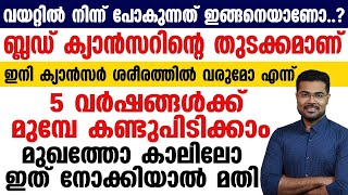 ഇനി ക്യാൻസർ വരുമോ എന്ന് 5 വർഷങ്ങൾക്ക് മുമ്പേ തന്നെ കണ്ടുപിടിക്കാം മുഖത്തോ കാലിലോ ഇത് നോക്കിയാൽ മതി