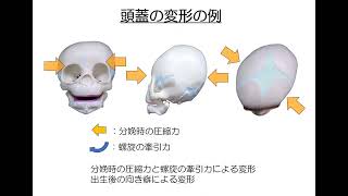 出生時の児頭回旋と体の歪みに関する考察