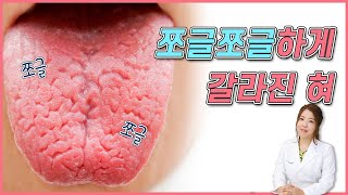 균열설+경면설: 혀가 쪼글쪼글하게 갈라졌어요. 혓바닥 주름이 생겼어요