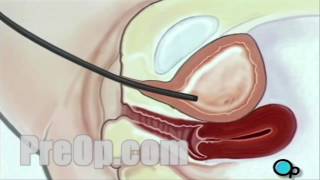 Cystoscopy Female Vaginal Surgery PreOp® Patient Education