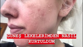 EYLÜL ÖZTÜRK-GÜNEŞ LEKELERİMDEN NASIL KURTULDUM-CİLTBAKIMI