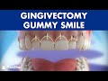 Gingivectomy - Treatment for gummy smile ©