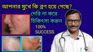 Homoeopathic doctor || মুখের ব্রণ দূর করার গ্যারান্টি যুক্ত হোমিও ঔষধ || Dr SP Goswami