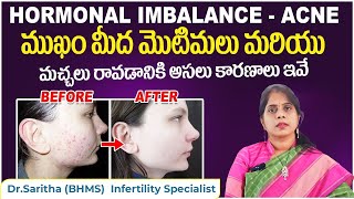 మొటిమలు రావడానికి కారణాలు | Causes Of Hormonal Acne | Skin Care Tips Telugu || Dr.Saritha