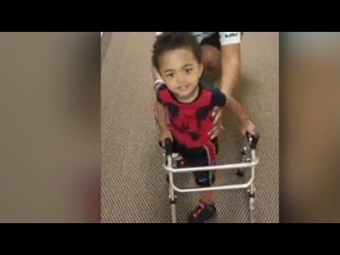 Toddler amputee's story will melt your heart