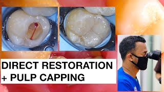 Direct Restoration with Pulp Expose | Pulp Capping | Dokter Gigi Griya RR