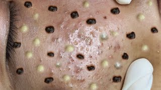 Big Pimples | Acne Treament Under The Skin #03 | Relax Every Day With Thuy Truong Sac Dep Spa | Acne