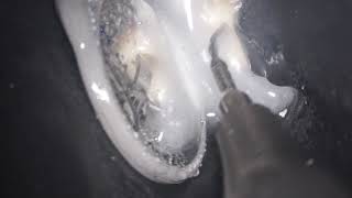 Easy Technique to remove temporary cement during Endodontic Treatment