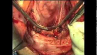 Total Abdominal Hysterectomy | Atlas of Gynecologic Surgery