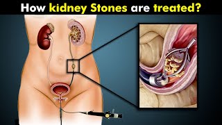 Removal Of Kidney Stones | How kidney Stones are removed? (Urdu/Hindi)