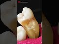 hidden tooth cavity asmr dentist