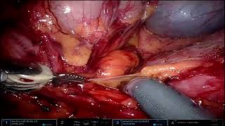 Kocher maneuver in robotic esophagectomy