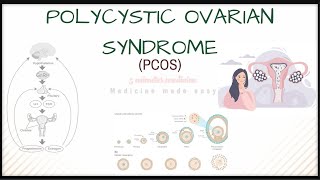 POLYCYSTIC OVARIAN SYNDROME (PCOS): Causes, pathophysiology, diagnosis, treatment