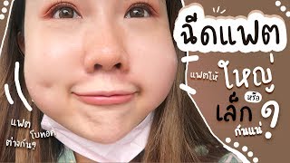 REVIEW : ทำยังไงถึงหน้าเล็ก / ฉีดโบท็อกซ์กับแฟตต่างกันยังไง ?🙈  | fondlys