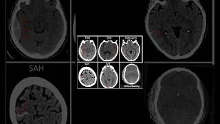 Managing a severe head injury