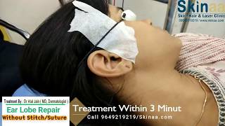 Ear Lobe Repair Treatment Without Stitch & Suture | Skinaa Clinic, Jaipur