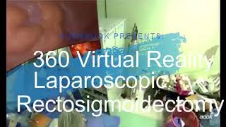 360/VR Laparoscopic Rectosigmoidectomy, full version on SurgBook