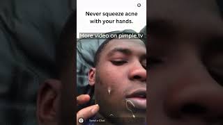 Never squeeze acne with your hands.