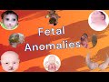 Fetal Anomalies