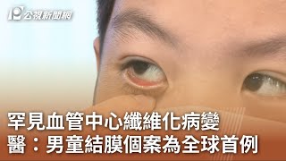 罕見血管中心纖維化病變 醫：男童結膜個案為全球首例｜20230720 公視中晝新聞