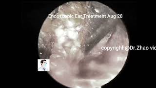 Cholesteatoma of the external auditory canal (depigmented) without anesthesia, 11 min