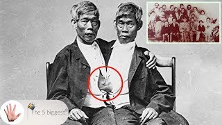 Conjoined Twins Got Married and Had 21 Children! Full Story of The Siamese Twins! ~ Body Bizarre!