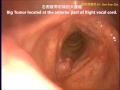 喉部聲帶腫瘤 喉閃頻攝影 劉耿僚醫師 laryngeal tumor glottic vocal cord tumor stroboscopy