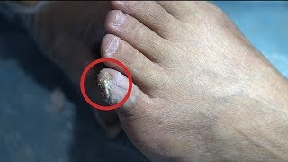 TOP MEDICAL PEDICURE PODIATRY 14 - Plantar foot wart treatment