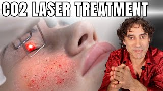 WATCH LASER SKIN TIGHTENING PROCEDURE // Dr Rajani