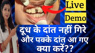 दूध के दांत नहीं गिरे और पक्के दांत आ गए तो क्या करें? |Milk Teeth Not Falling |All About Milk Teeth