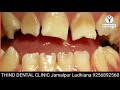 difference between normal denture u0026 implant dentures उतारने चढ़ाने वाले दांत या फिक्स दांत