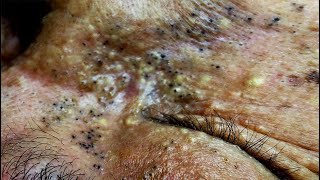 Deep blackheads removal new, big pimple pop up, blackheads extraction 2021 newest #blackheads #acne
