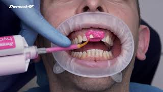 Dental Clinical Procedure for Single Unit Crown - Chapter 1: Master Impression