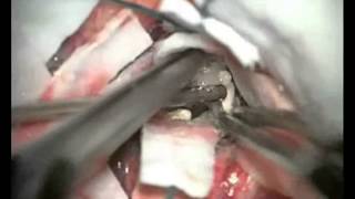 Surgical Treatment of Cerebral Intraventricular Neoplasms