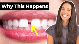 Why Do People Have GAP TEETH \u0026 How To Fix It (Diastema Explained)