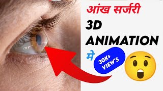 आंख का सर्जरी 3D ANIMATION में #shorts #facts #viral #short #fact #amazing #trending #youtube
