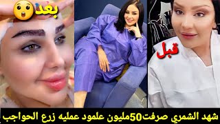 شهد الشمري تسوي عملية زرع حواجبها تكول كلفتني50مليون/ياخذون شعر من الابط بس وجه يصير بي ريحه صنان