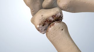 Osteoarthritis of the Thumb