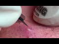 Make your Acne Treatment Huong Da Nang | 471# acne 2022