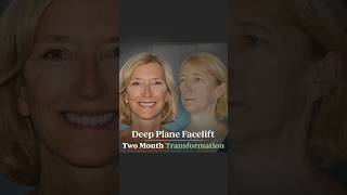 Janice’s BEAUTIFUL Deep Plane Facelift