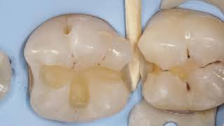 Direct posterior composite ( caries )