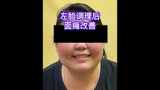 左脸面瘫（bell palsy）