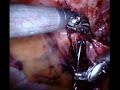 robotic tapp transabdominal preperitoneal hernia repair