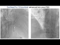 case 115 manual of cto interventions bifurcation at distal cap and retrograde crossing