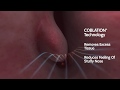 Nasal turbinates and turbinate reduction