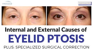 Differentiating Types of Eyelid Ptosis, and its Specialized Surgical Correction