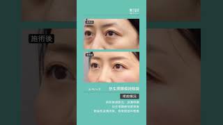 仿生理隱痕祛眼袋案例 #eyebag #eyebagremoval #眼袋內開 #眼袋手術