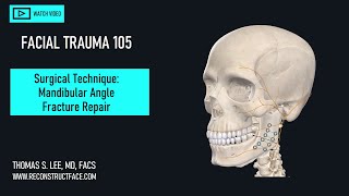 Mandible Angle Fracture Repair Basics: How-To and Commonly Asked OR Questions [105] Didactic