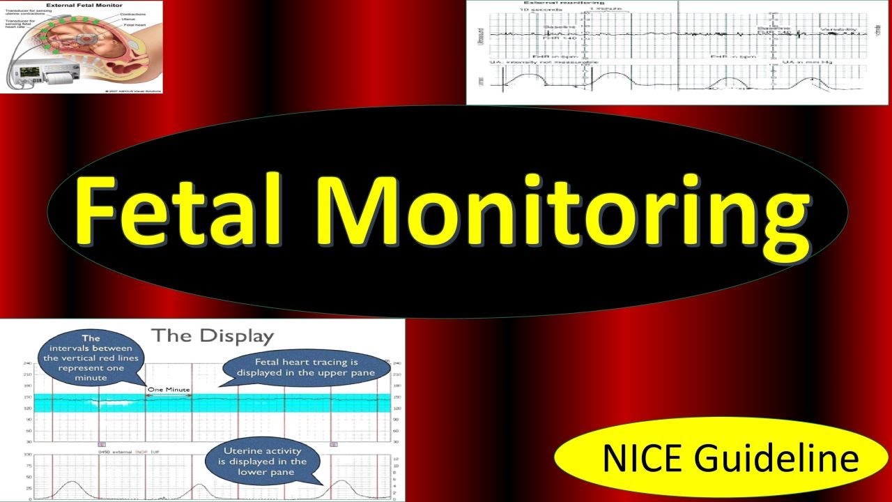 Fetal Monitoring In Labor, NICE Guideline (2022) / Updates In ...